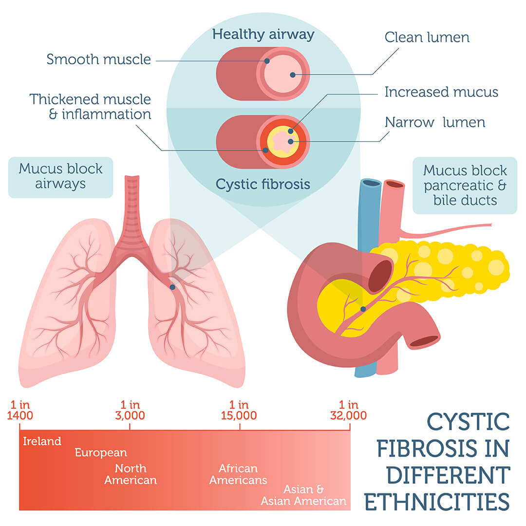 cystic-fibrosis-dna-test-dna-access-lab