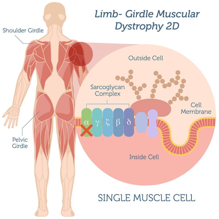 Muscular dystrophy. Muscular Dystrophy, Limb-girdle, autosomal recessive 1 (253600), ar.