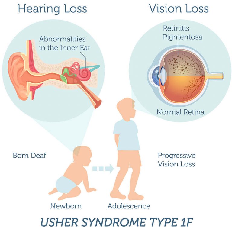 usher syndrome type 2a